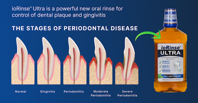 New Study Reveals Importance of Rinsing in Preventing Dental Implant Loss