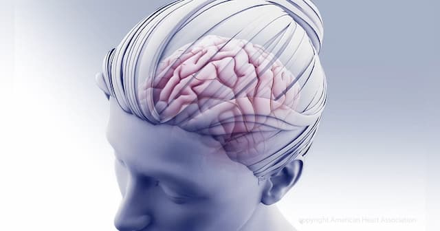 Lower Cognitive Scores in 60s Linked to Higher Stroke Risk