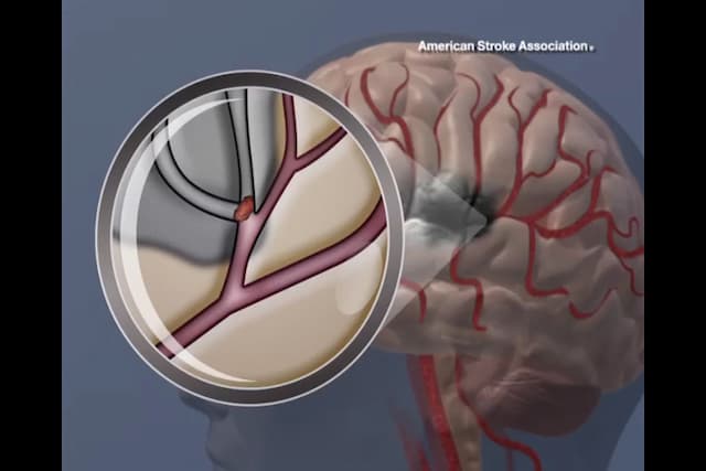 New Stroke Drug Cuts Recurrence Risk 26% Without Bleeding Danger