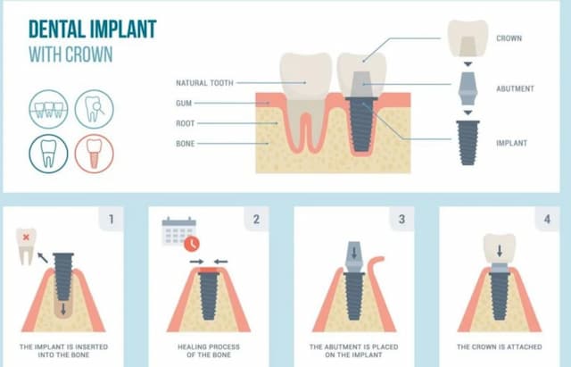 Fort Worth Dentist Makes Dental Implants Affordable Without Sacrificing Quality