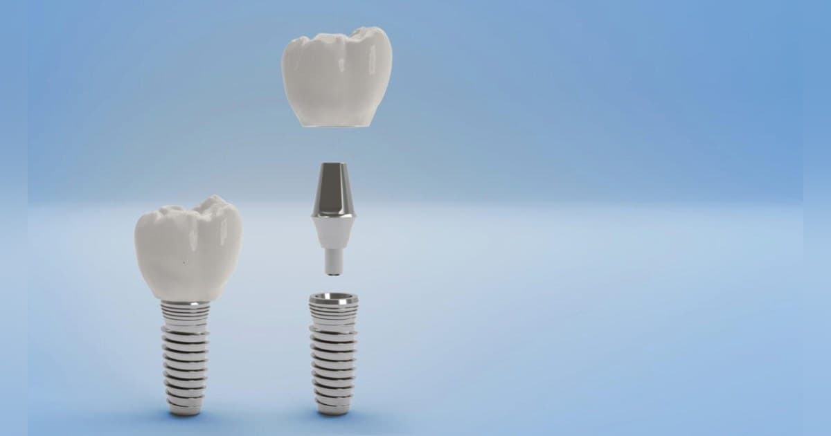 Boulder Dentist Reveals Key Differences in Teeth Whitening Options