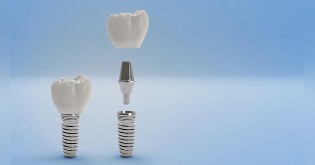 Boulder Dentist Reveals Key Differences in Teeth Whitening Options