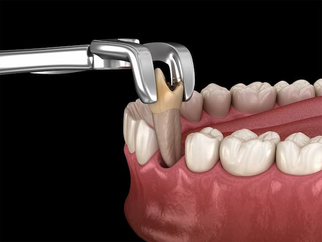 Sioux Falls Tooth Extraction: 5 Key Facts Patients Need to Know
