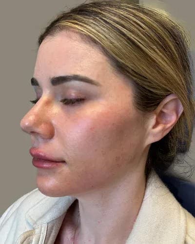 Laser Center of Marin Unveils 8-Week Bridal Glow Package
