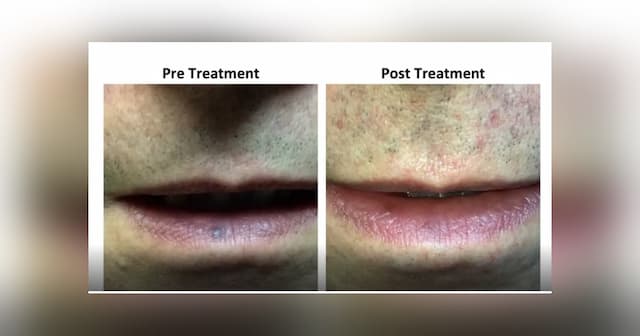 Vascular Surgeon Treats Benign Lip Lesion with Laser