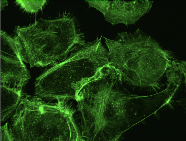 Citius Pharmaceuticals Advancing Oncology Asset, Paving Way for Spin-Out of Advanced T-Cell Lymphoma Treatment
