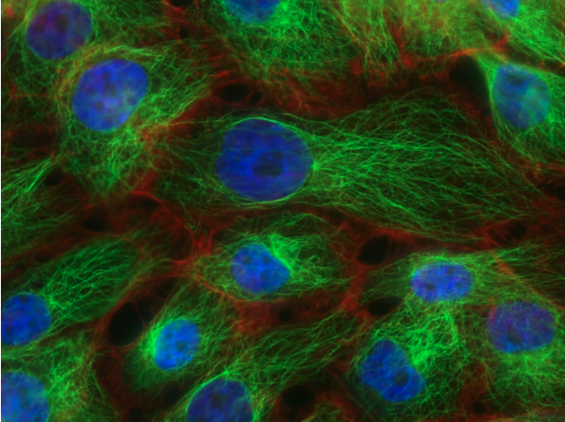 Game-Changing Tumor-Freezing Technology Offers Minimally Invasive Alternative to Breast Lumpectomy