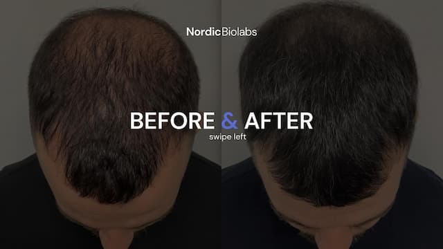 Nordic Biolabs: Revolutionizing Men's Hair Regrowth with Innovative Products