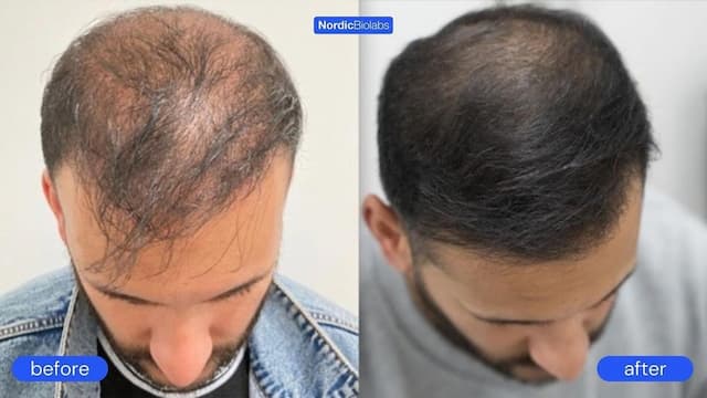 Empowering Men: Nordic Biolabs' Innovative Approach to Hair Recovery