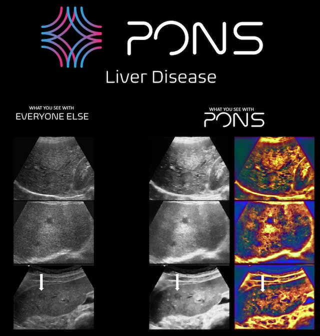 PONS Receives WIPO Global Award for Pioneering Ultrasound Imaging