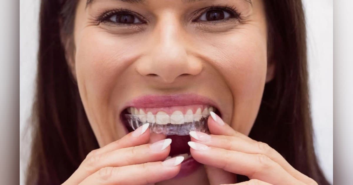 Clear Aligners in Baton Rouge: Discreet Overbite & Crossbite Fix